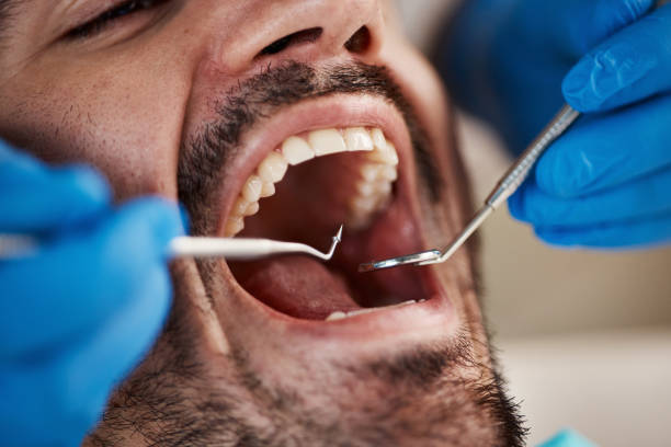 Emergency Dental Filling Replacement in NJ